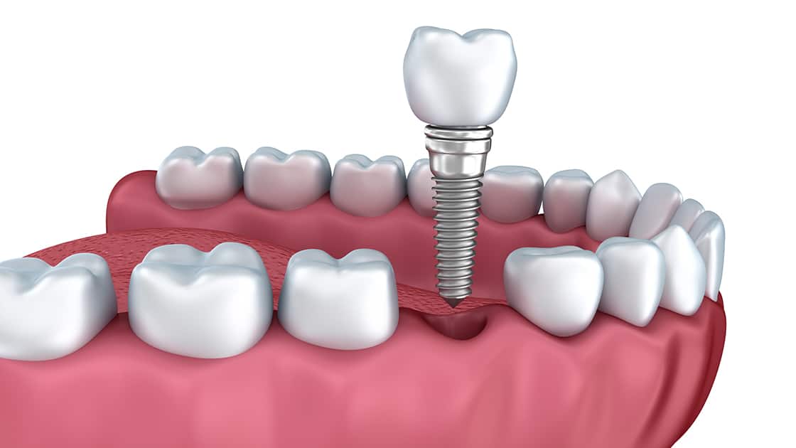 Single Implant Image