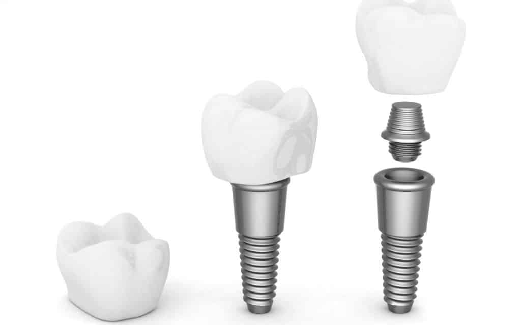 Home Care for Your Dental Implants