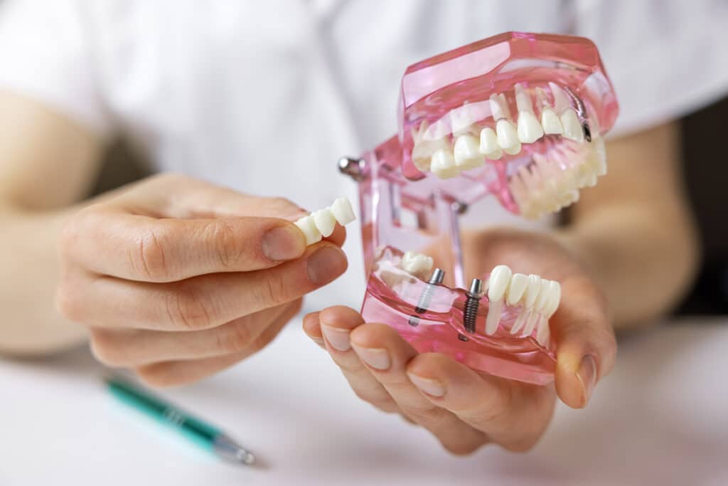 Full-Arch Dental Implants vs. Traditional Dentures: Pros and Cons