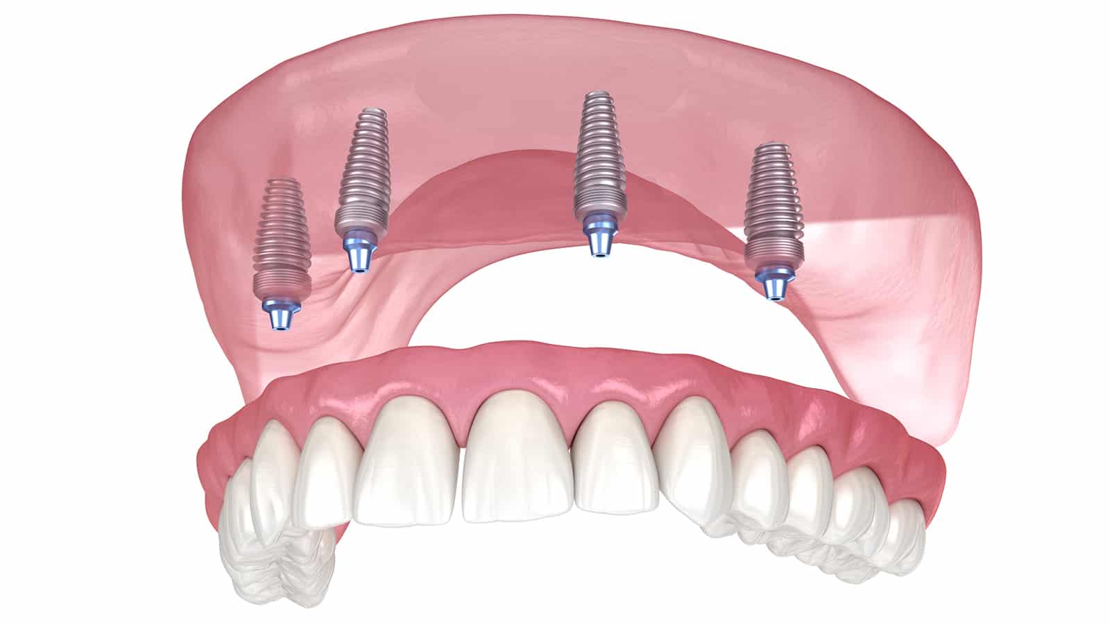 Fulll Arch Dental Implant