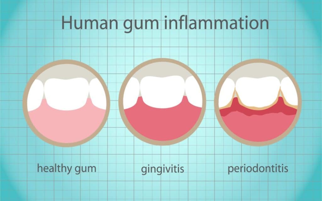 gum disease infographic