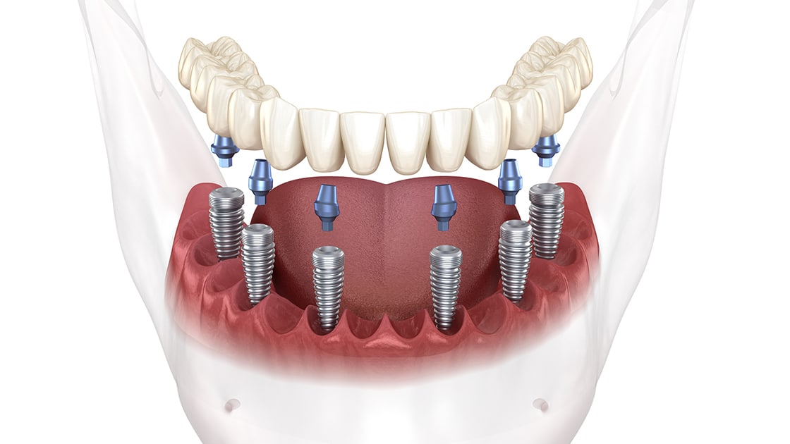 Full Arch Dental Implant Illustration