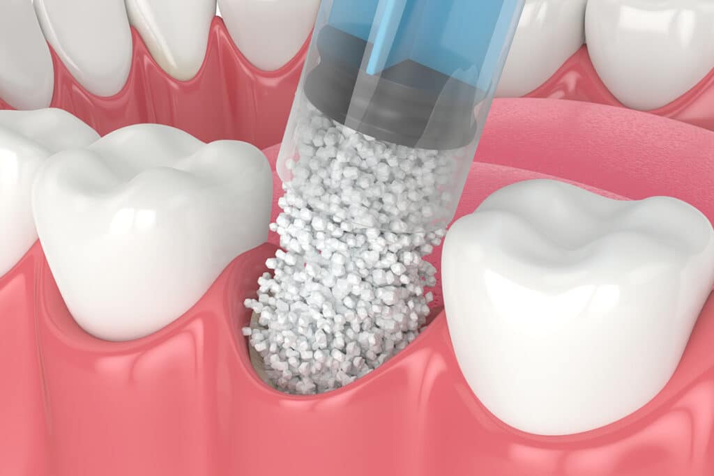 Is Bone Grafting Painful? What Lincoln Patients Should Know