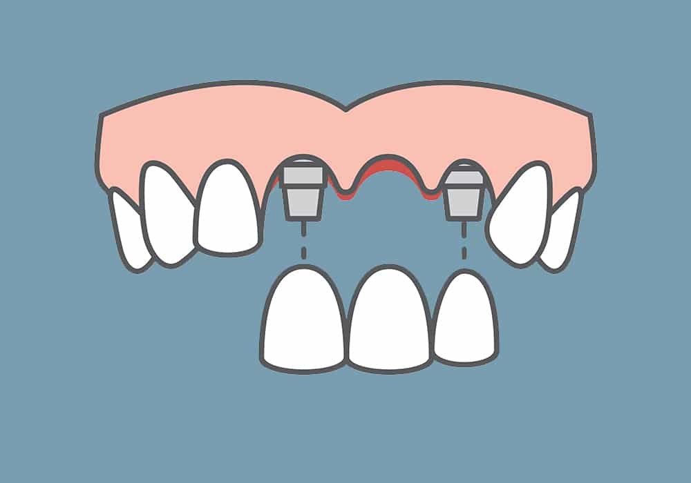 Multiple Teeth Solutions Photo