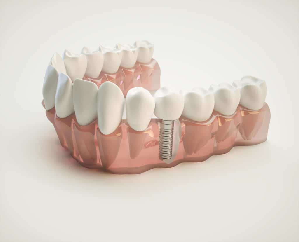 model of teeth with a dental implant