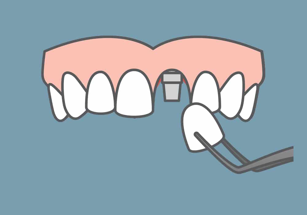 Single Tooth Solution - Photo