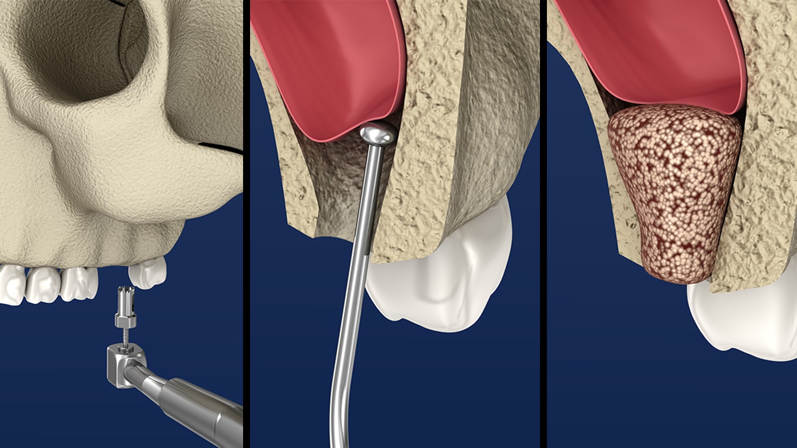 Sinus Lift 