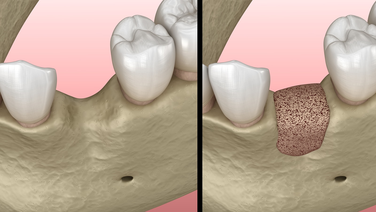 Bone Graft Illustration