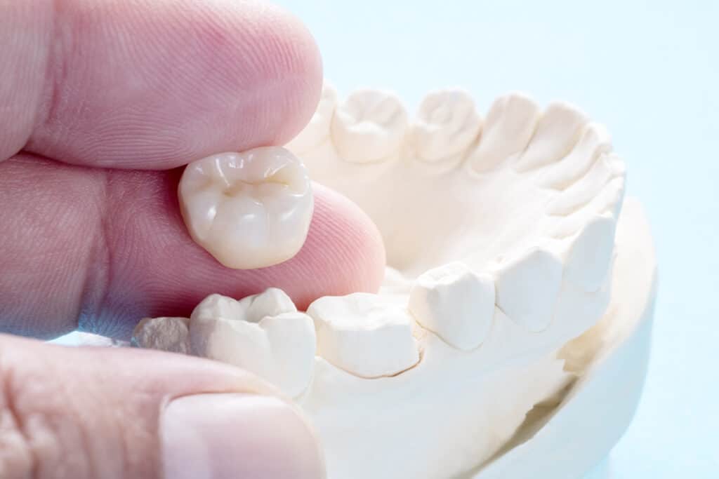 Why You Might Need a Dental Crown After a Root Canal
